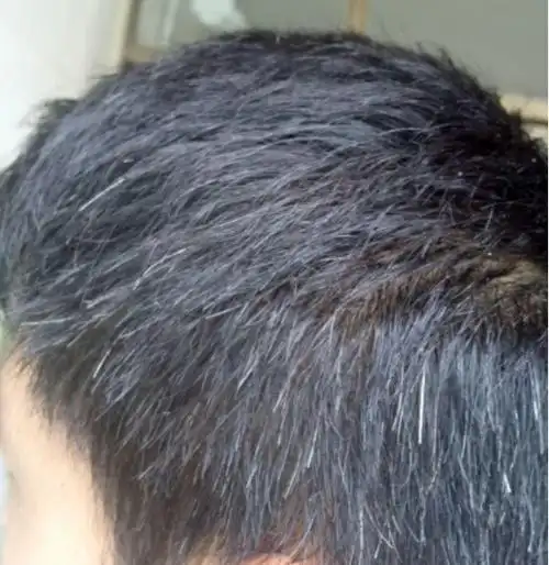 有什么办法可以补救白头发吗?