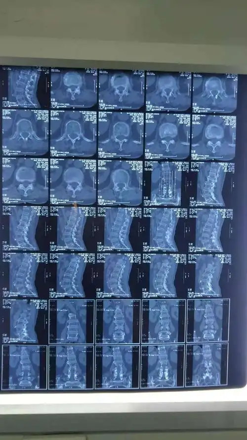 休息后疼痛没有减轻,来我院就诊,经查体拍片诊断为胸12椎体压缩性骨折