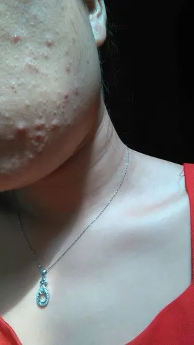 脸上起这种小疙瘩一个多月了该怎么办啊