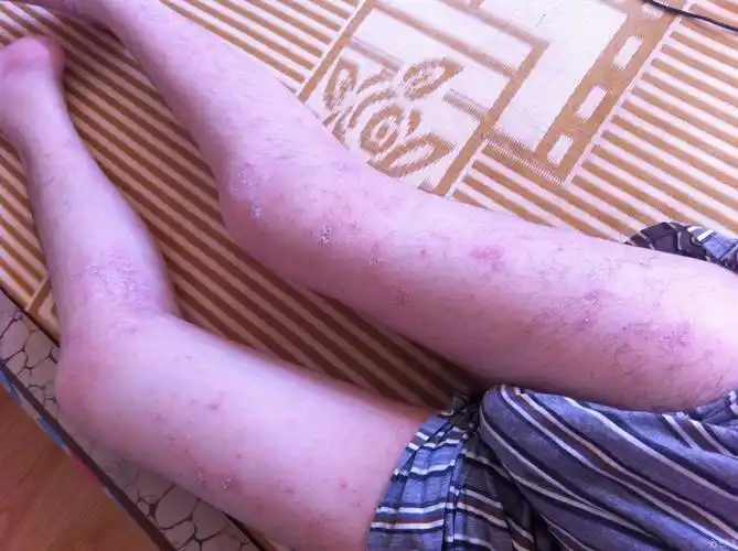 第二次求助我的湿疹是否真的不可治愈