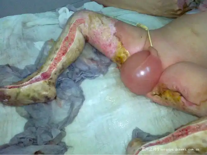 转两岁孩子掉石灰坑严重烧伤希望好心人帮忙救助