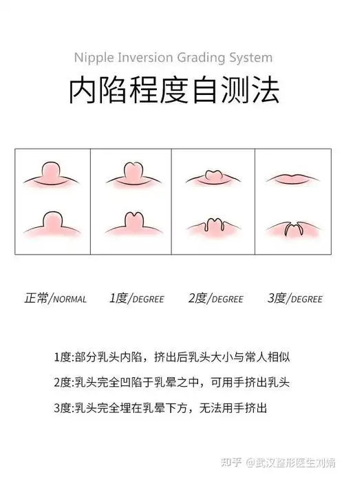 自测一下您是否存在乳头内陷