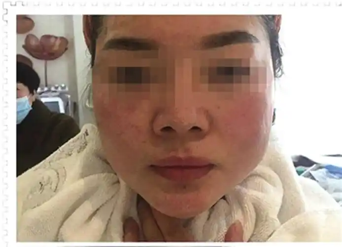 整容变毁容曝光恩施州城一美容院非法行医被没收所得