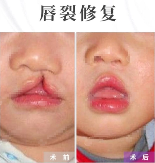 兔唇和吃兔肉有关吗?