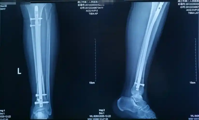 42岁胫腓骨骨折闭合复位髓内钉内固定手术一例