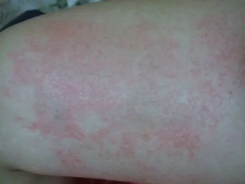 所患疾病:湿疹 病情描述:腿部皮肤痒的厉害,经常对称着长,不起疙瘩,光