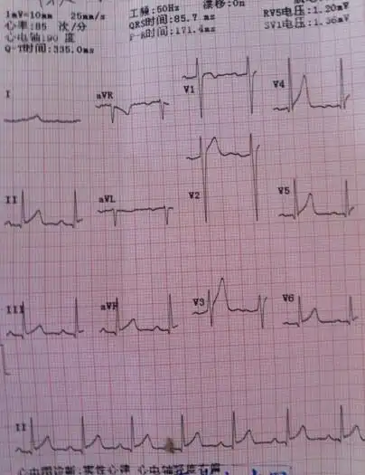 电轴轻度右偏都是正常人可以出现,电轴右偏是与个人的肥胖程度有关系