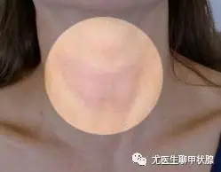 我们该怎么自检甲状腺?