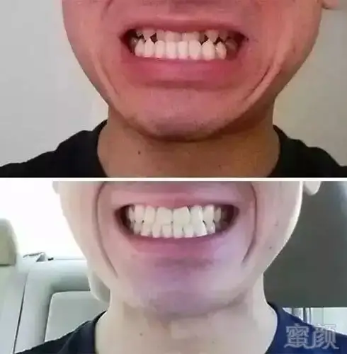 地包天,曾经以为我这辈子就这样了,牙齿整齐真的hin重要.