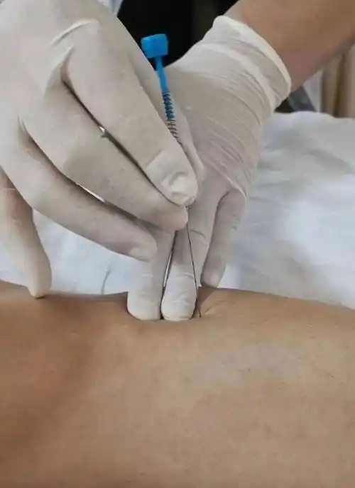 夏季减肥正当时 柔感埋线 健脾祛湿减肥(附辩证取穴)_穴位_腰围_功能