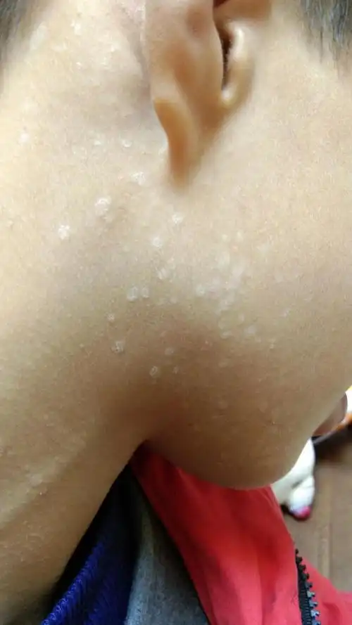 脖子腋窝汗斑长了一片?胳膊胸前背上越来越多?