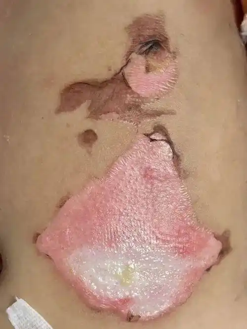 仅7个月大孩子,不慎被开水烫伤左大腿,下腹部,烫伤面积达18%,皮肤红肿