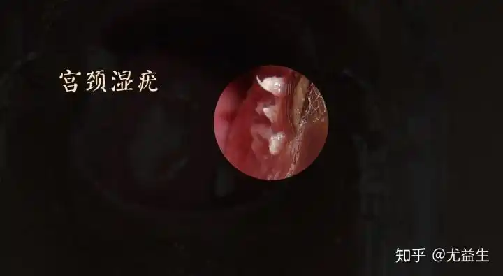 尤益生 公众号,湿疣之友 26人 赞同了该文章 尖锐湿疣是一种病毒感染