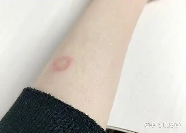 猫癣狗癣真的有这么缠人吗? - 知乎