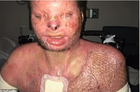 一名陌生人把他从燃烧的残骸中拖了出来,但他全身已80%重度烧伤