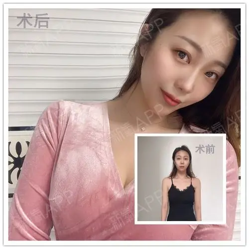 沈阳曼托假体隆胸1天——大家好,今天成功的做完了假_圈子-新氧美容