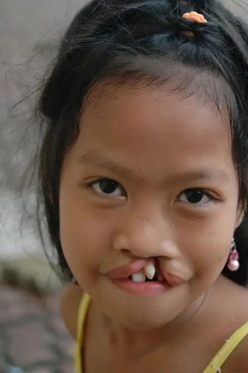 嫌孩子患兔唇治疗费太高,爷爷竟然在路边遗弃孙子