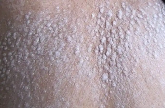 人到中年,平静对待牛皮癣_郑州市银屑病研究所