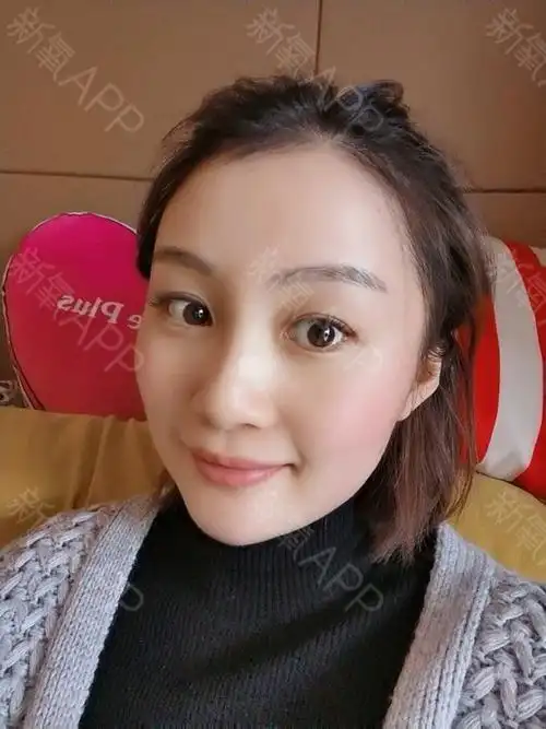 自体脂肪填充泪沟