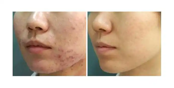 袪痘-红蓝光袪痘效果图,案例前后对比照片