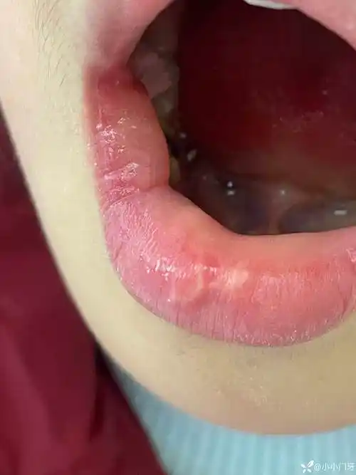 封氢氧化钙后5分钟嘴角泡了