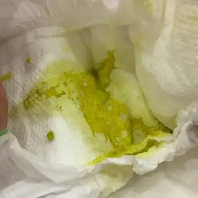 宝宝拉蛋花样粑粑怎麼回事?