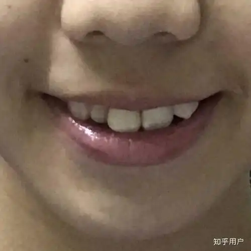 不对称 中线严重不齐