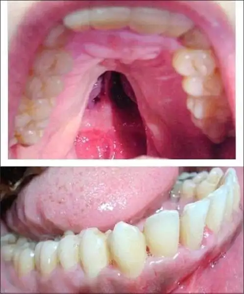 软腭裂是什么症状