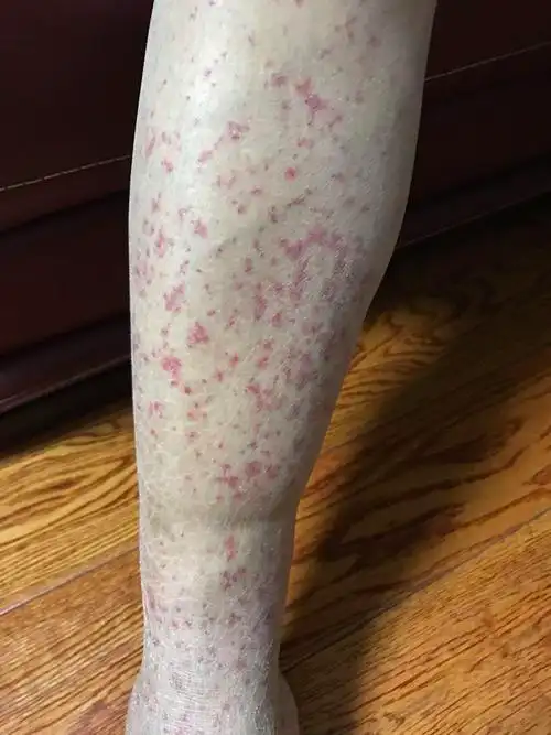 月腿上长了红色斑点,不痛不痒,但是双腿有无力的感觉,不愿意上下楼梯