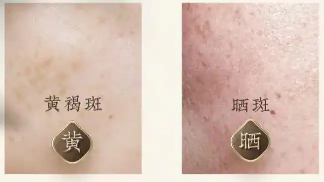 工作时容易长 辐射斑 生孩子时会长 妊娠斑 太阳晒多了还会长 晒斑!
