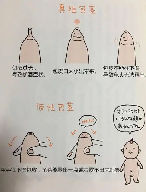 包皮要不要割包皮长短见仁见智不一定要手术