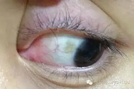 眼白为什么不白了?眼白出现这个颜色,你要小心了