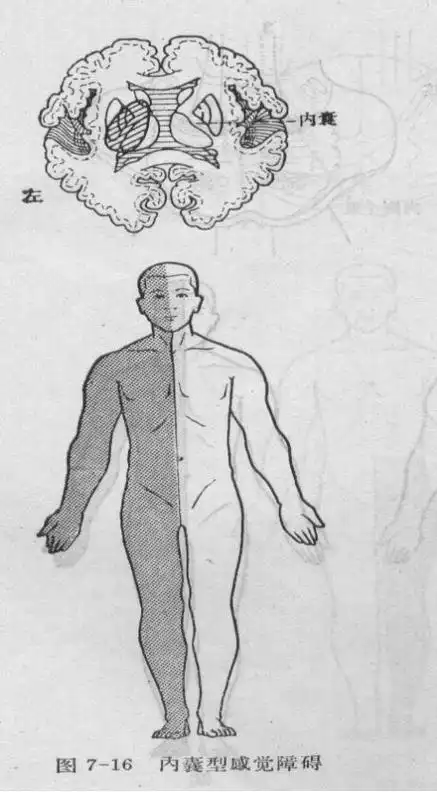 手脑感知系列临床中的感觉功能障碍