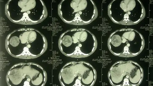 【原创病例】 原发性肝癌,看看手术机会