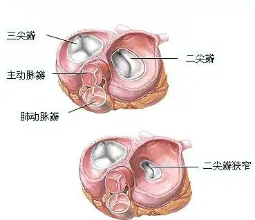 二尖瓣的介绍