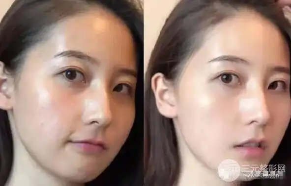 光子嫩肤水光美肌这才是夏季人人都需要的美白嫩肤的优解