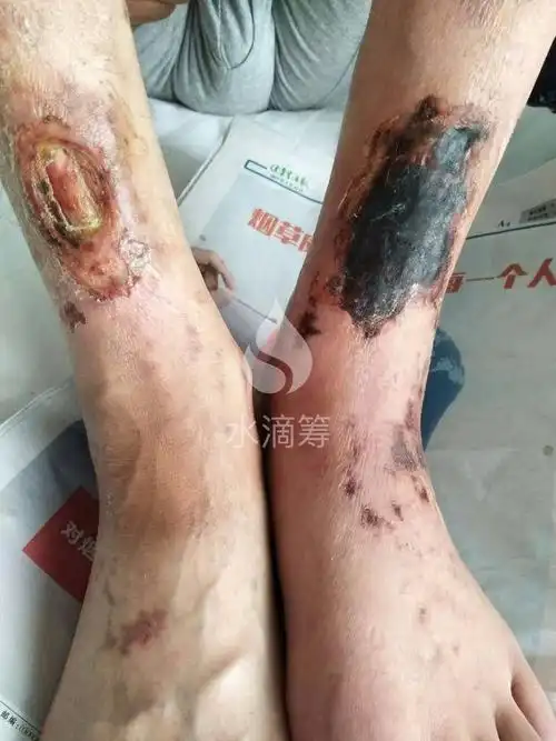 救救我吧双下肢溃烂面临截肢求帮助求转发