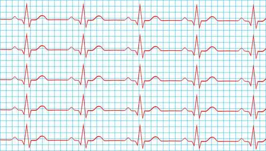 心脏正常的窦性心律的心电图记录照片