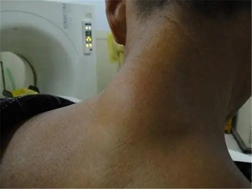 女子后颈部治疗脂肪瘤图片