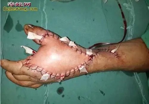 被五步蛇咬伤五步蛇咬伤急救方法