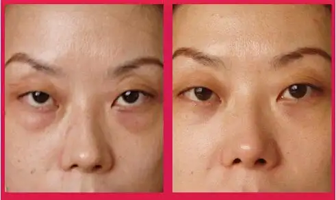 黑眼圈和黑眼袋有什么区别?