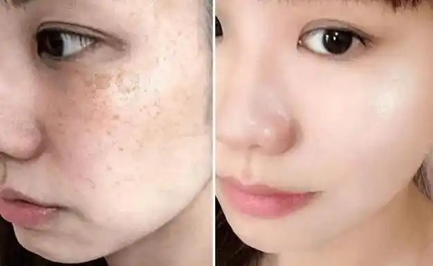 十大美白祛斑排行榜,哪款效果好?|淡斑|肤质|痘印|敏感肌肤_网易订阅