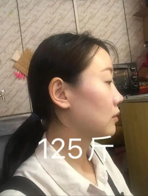 减肥20斤的侧脸变化大吗
