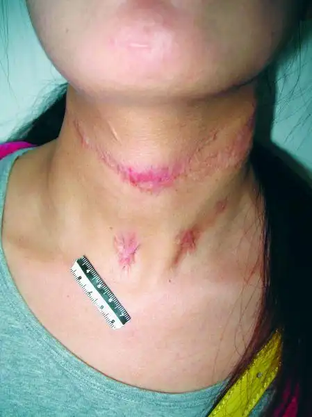 宁德10年前妙龄女被割喉装死侥幸逃过生死劫