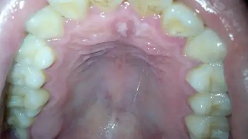 口腔白斑能够自愈吗