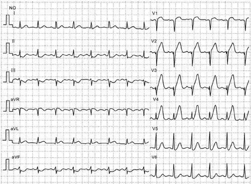 下面,我们通过病例,来复习一下心梗的不典型心电图表现.