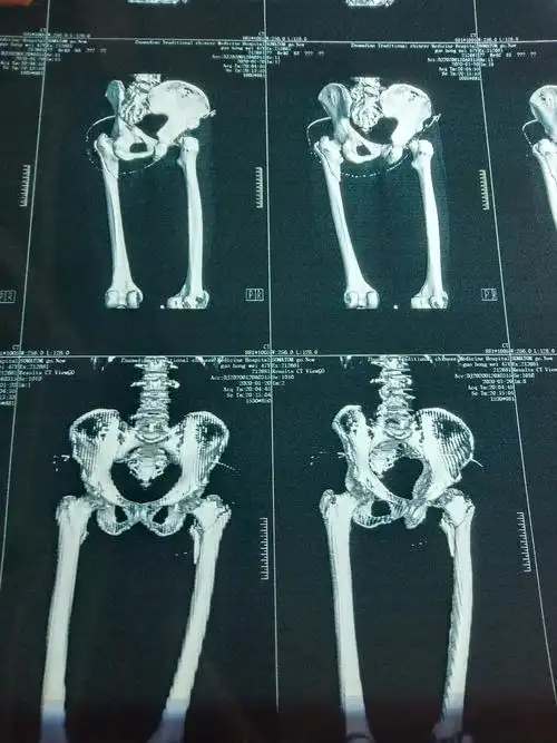 骨病科大年29行一例47岁左侧股骨转子间粉碎性骨折切开复位pfna内固定