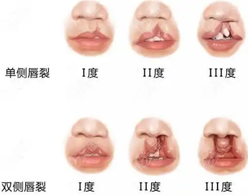兔唇,唇裂,唇腭裂是有区别的,唇裂修复的方法也不同