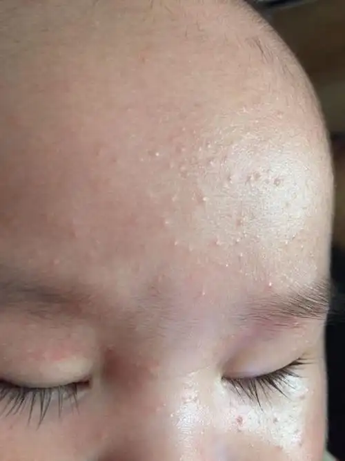 我家宝贝这两天脸上出了好多这种小点点呀?请问哪位宝妈知道这是