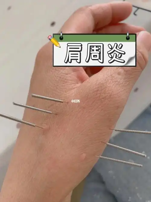 针话第51集|【肩周炎】上班族,电脑族,学生党